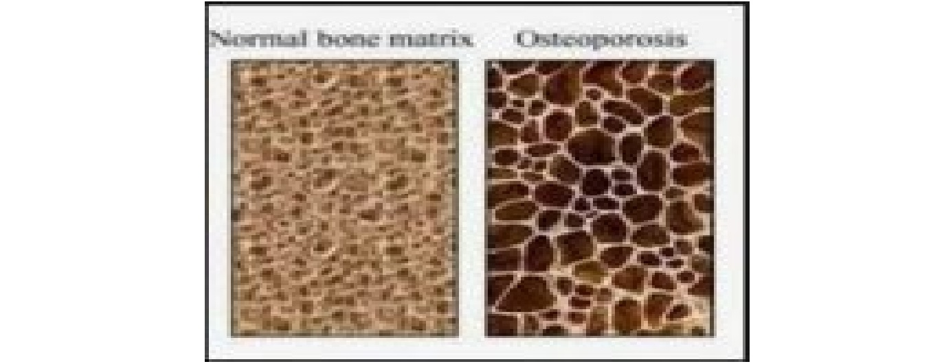 تعیین پوکی استخوان به روش Dexa